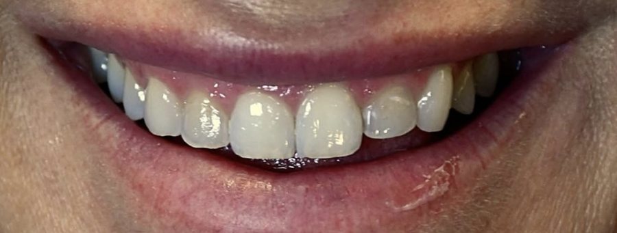 Smile before a gum lift, with an uneven gumline