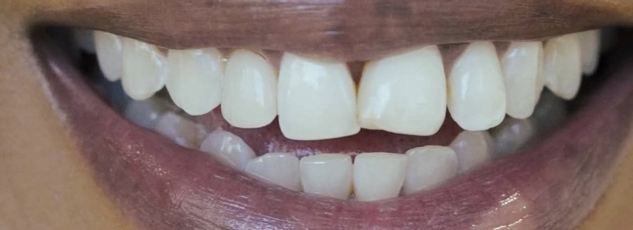 Smile before Invisalign, with a gap and uneven front teeth