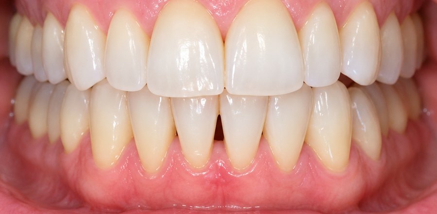 The same teeth after Invisalign, with the bite closed
