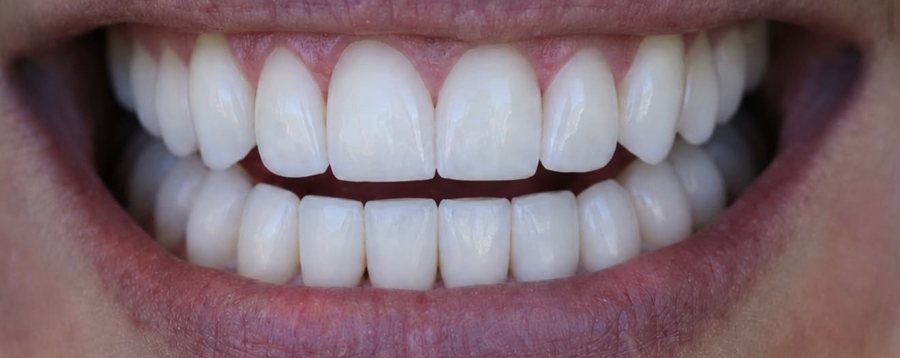 The same smile after bonding and veneers