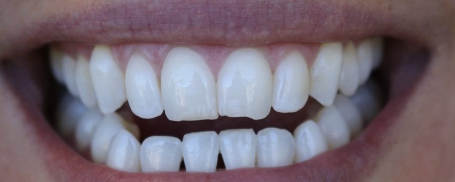 Smile before treatment, with gaps and uneven edges